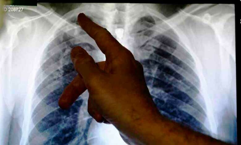 OMS: nuevo tratamiento oral contra la tuberculosis